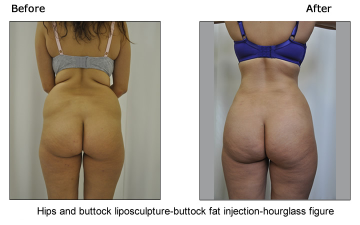 Buttock Lift Photos
