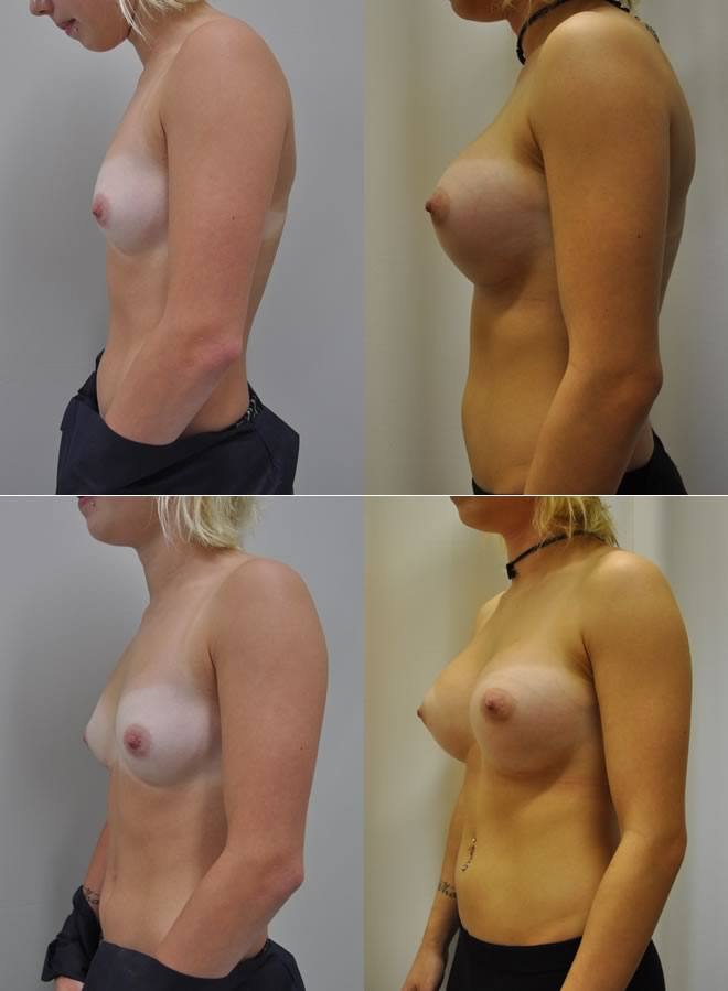 Breast Implant Before and After Gallery.