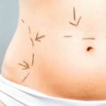 Tummy Tuck