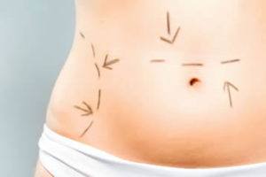 Tummy Tuck