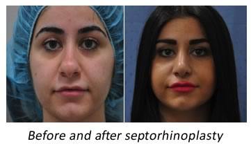 before and after nose surgery sydney