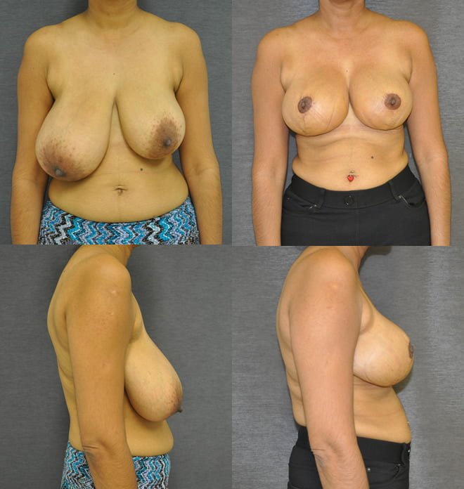 Breast Lift / Reduction.