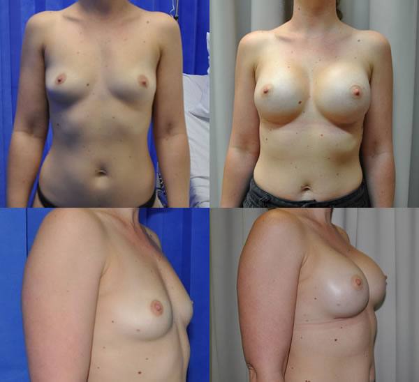 320cc round implants. Natural results