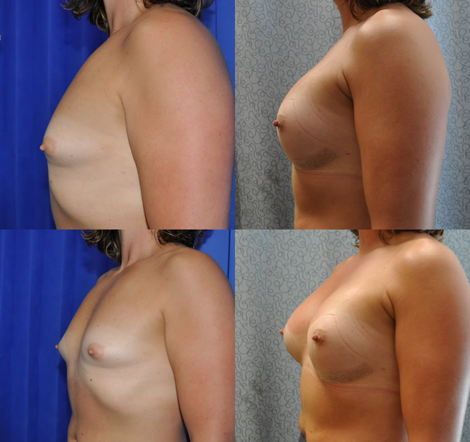 360cc natural round implants by Dr Barnouti