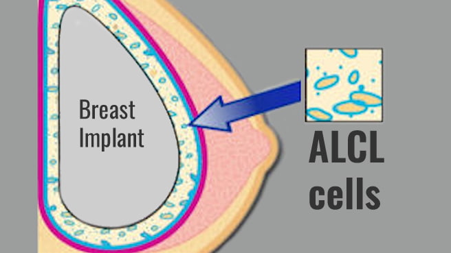 BI-ALCL