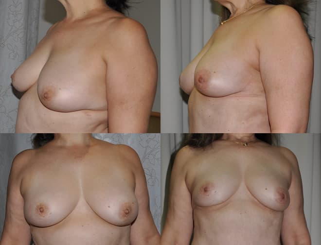 Breast Lift - reduction