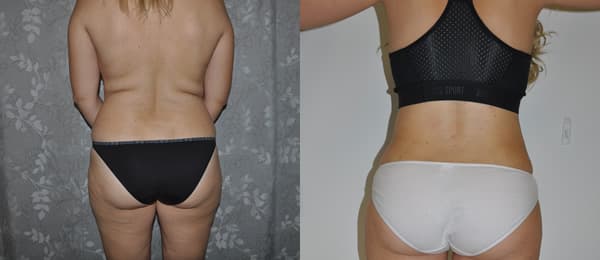 Lipo Before After