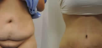 Abdominoplasty Before After