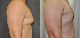 Male Breast Reduction Before After Gallery