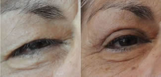 Eye Bag Lift Before After Gallery