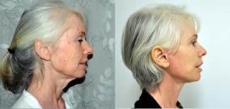 Face and Neck Lift Gallery