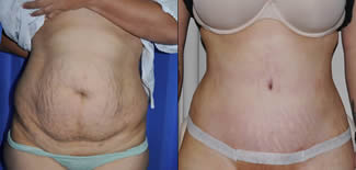Abdominoplasty Before After 