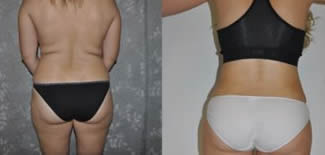 Liposuction Before After Gallery