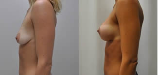 Breast Lift Before After Gallery