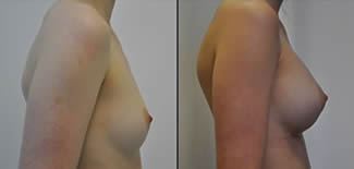 Breast Implant Before After Gallery