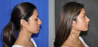 Rhinoplasty Before After Gallery