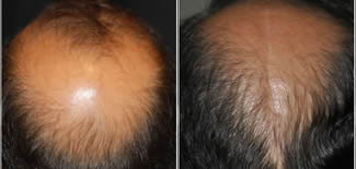 Scalp Reduction Before After Gallery