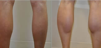 Calf Implants Before After Gallery