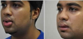 Lip Reshaping Before After Gallery