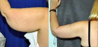 Arm Lift Before After Gallery