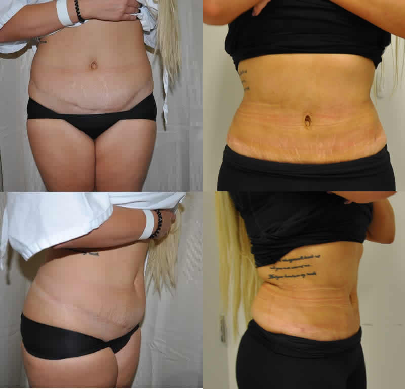 Before - Initial Surgery performed by others. After: Revision abdominoplasty and sculpture by Dr Barnouti