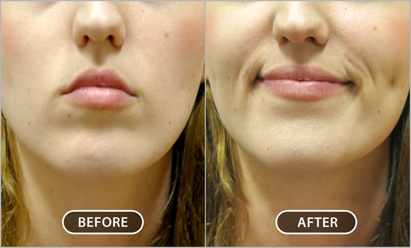 Shallow dimple – the dimple shows only at animation. Shallow dimple – the dimple shows only at animation.