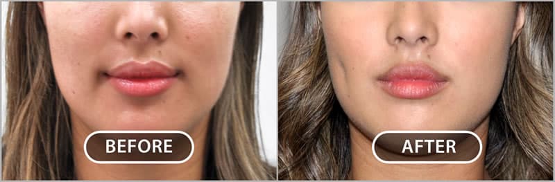 Deep dimple – this dimple shows at rest and at animation. Deep dimple – this dimple shows at rest and at animation.