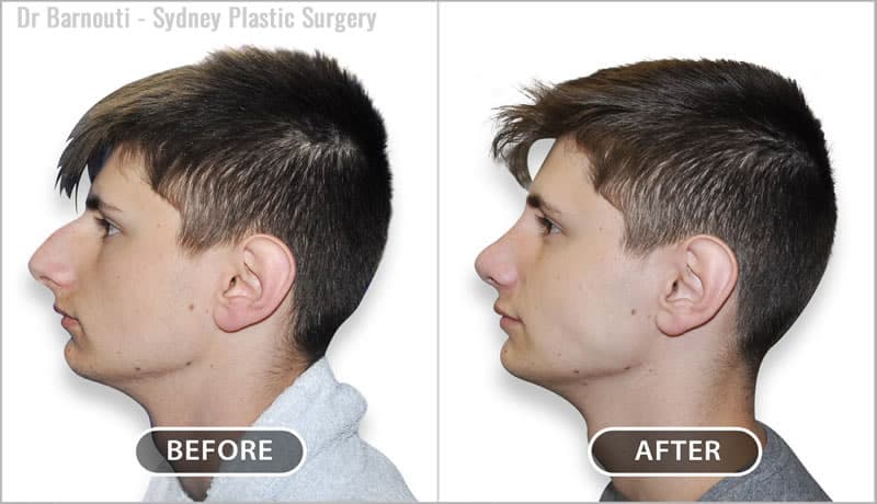 Face and Neck Surgery Before/After