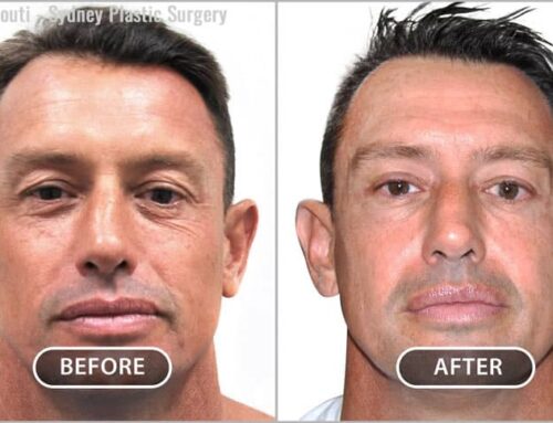 Eyelid Surgery