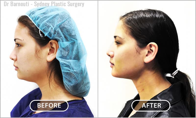 This patient had neck liposuction and buccal fat pads removal.