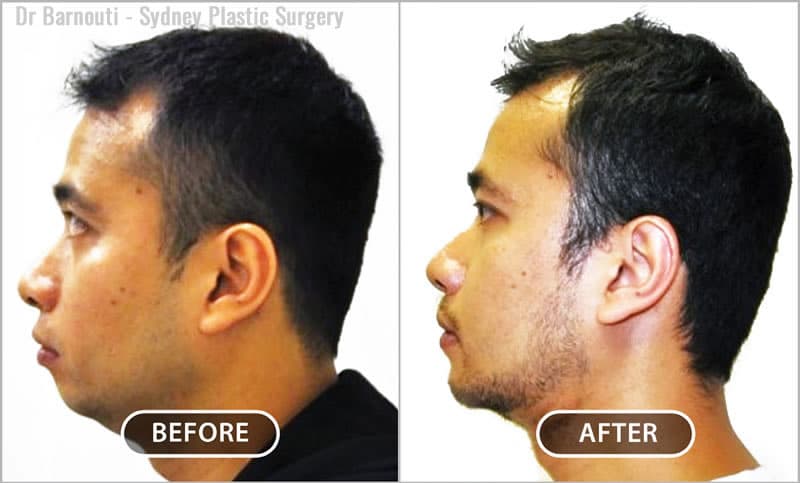 This patient’s facial profile was strengthened considerably, and a youthful appearance was obtained.