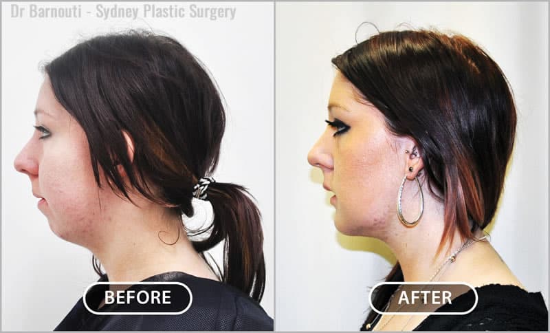 Chin augmentation had a significant effect on this patient’s overall facial appearance, even defining her cheeks and neck.