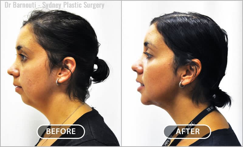 Chin augmentation surgery and neck liposuction.