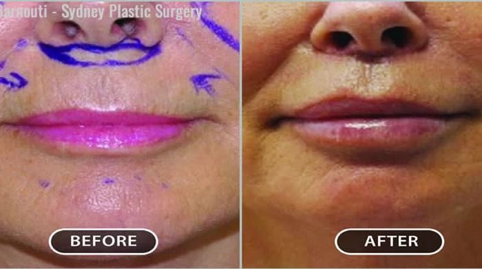 This patient had a lip lift and augmentation.