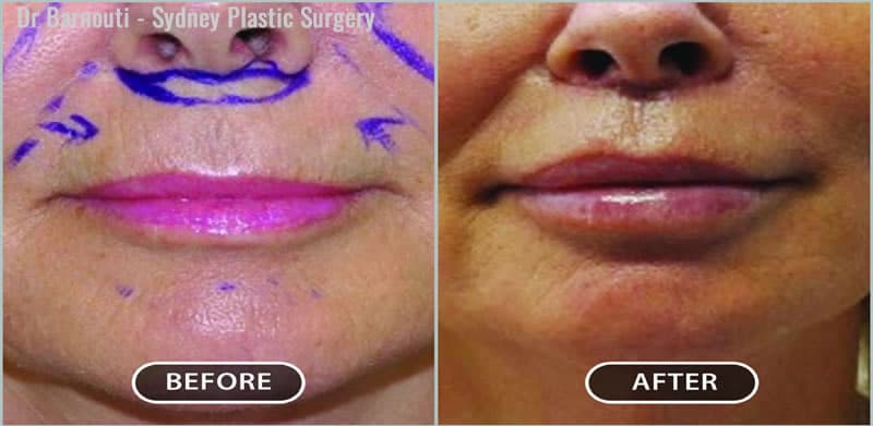 This patient had a lip lift and augmentation.