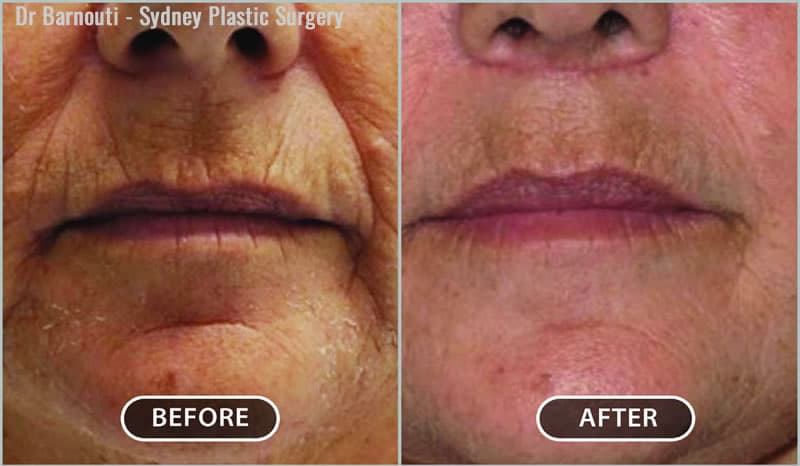 Rejuvenation of the lip and chin area using fat injections, a lip lift and laser treatment.