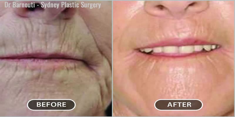 This patient’s lip lift and laser treatment resulted in a much smoother and rejuvenated appearance.