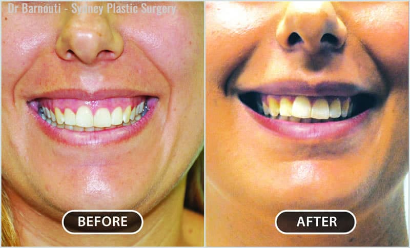 This patient had her gummy smile corrected. This patient had her gummy smile corrected.