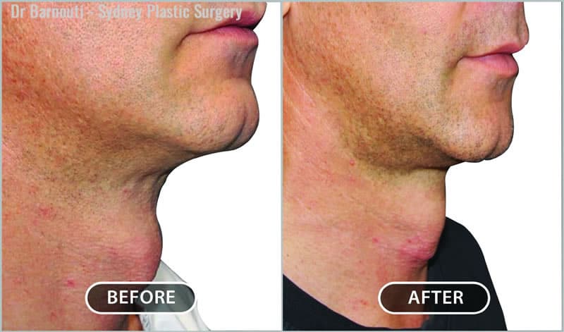 This patient had tracheal shave surgery. This patient had tracheal shave surgery.