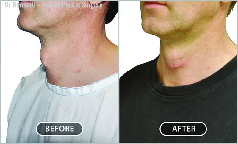 This patient had tracheal shave surgery.