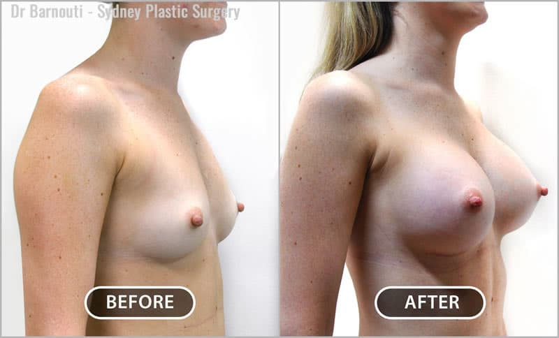 Breast augmentation with 360cc round breast implants; dual plane.