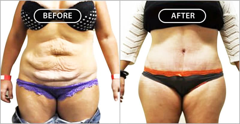 Notice the new small belly button, the waistline liposuction, the low-seated scar and the attractive midline groove. Notice that the scar is completely hidden by the patient’s clothing.