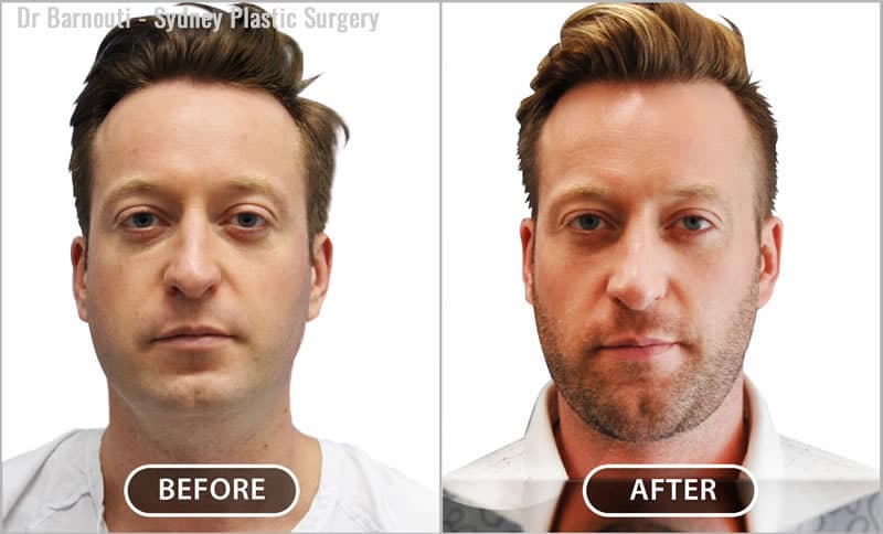 This patient presented requesting rhinoplasty. He was advised that his main issue was lack of volume in the mid-face and chin area, and excess neck fat. I recommended fat injections to augment his cheek and chin area, which I performed together with neck liposuction. The surgery produced harmonious facial features. A rhinoplasty procedure would have been the wrong choice.