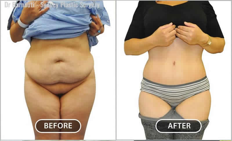 You can see the amazing transformation in these patients after their tummy tucks and liposculpture. Notice the creative upper tummy abs shadow line.