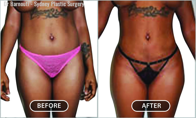 Abs/Flanks - KleinLipo - Liposuction Surgery of Orange County