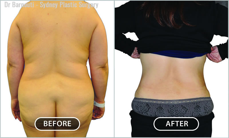 Liposuction - Before After Gallery