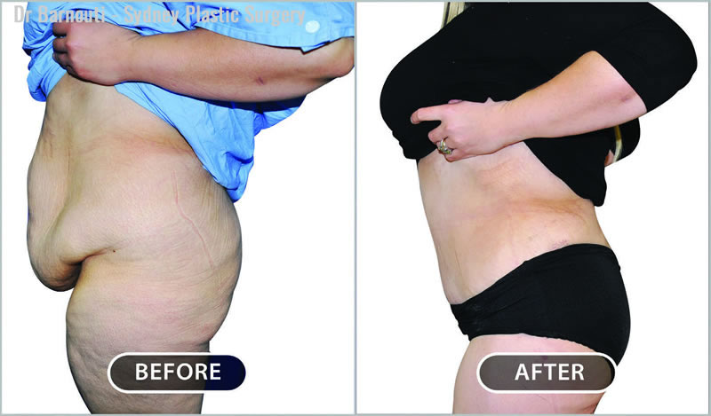 Excess skin removal is often necessary after excessive weight loss. A number of procedures were performed on these patients, including pubic lift, repaired muscle separation, and liposculpture.