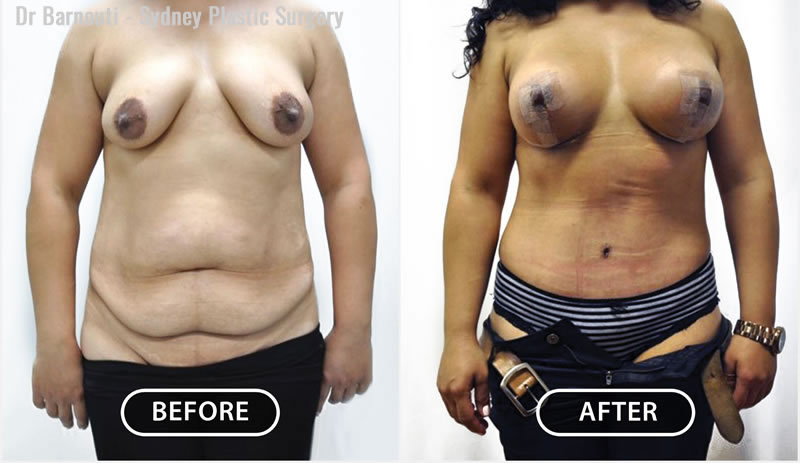 A five-hour Mummy Makeover has transformed this women’s body.