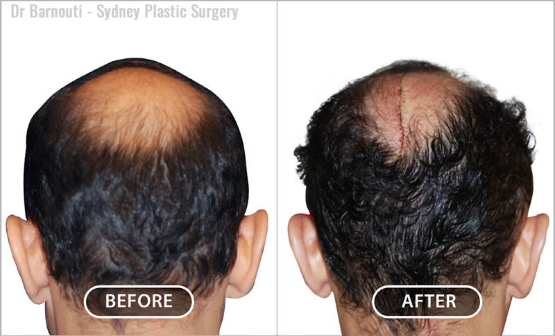 Before and after scalp reduction surgery.