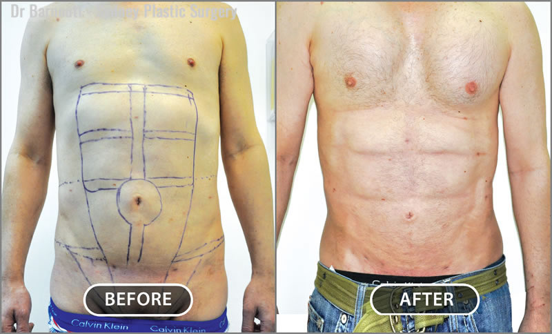 Abdominal Etching/Pectoral Implants/Liposculpture Before After Gallery Abdominal Etching/Pectoral Implants/Liposculpture Before After Gallery